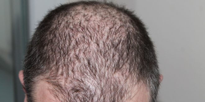 Haartransplantation: Das sollten Sie beachten